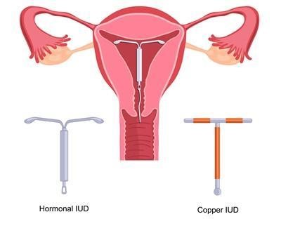 Hormonspiral og kobberspiral og billede af ops&aelig;ttelse af spiralen i livmoderen